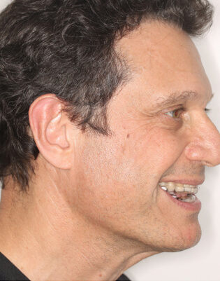 Fotografía de perfil de primer plano de muestra de dispositivo de avance mandibular