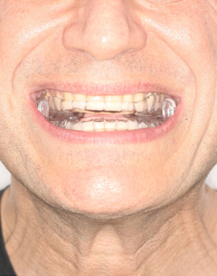 Fotografía de primer plano de muestra de dispositivo de avance mandibular